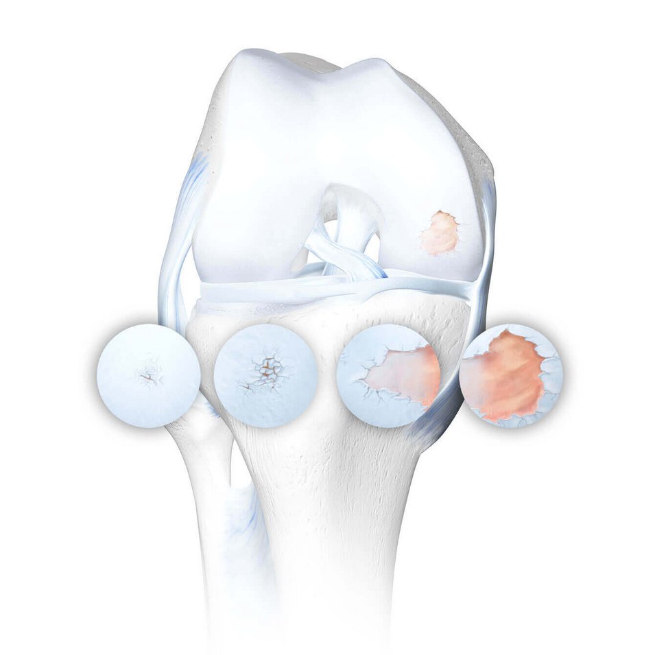Grafische Darstellung eines Kniegelenks mit Arthrose, in vier Stadien fortschreitender Knorpelschädigung