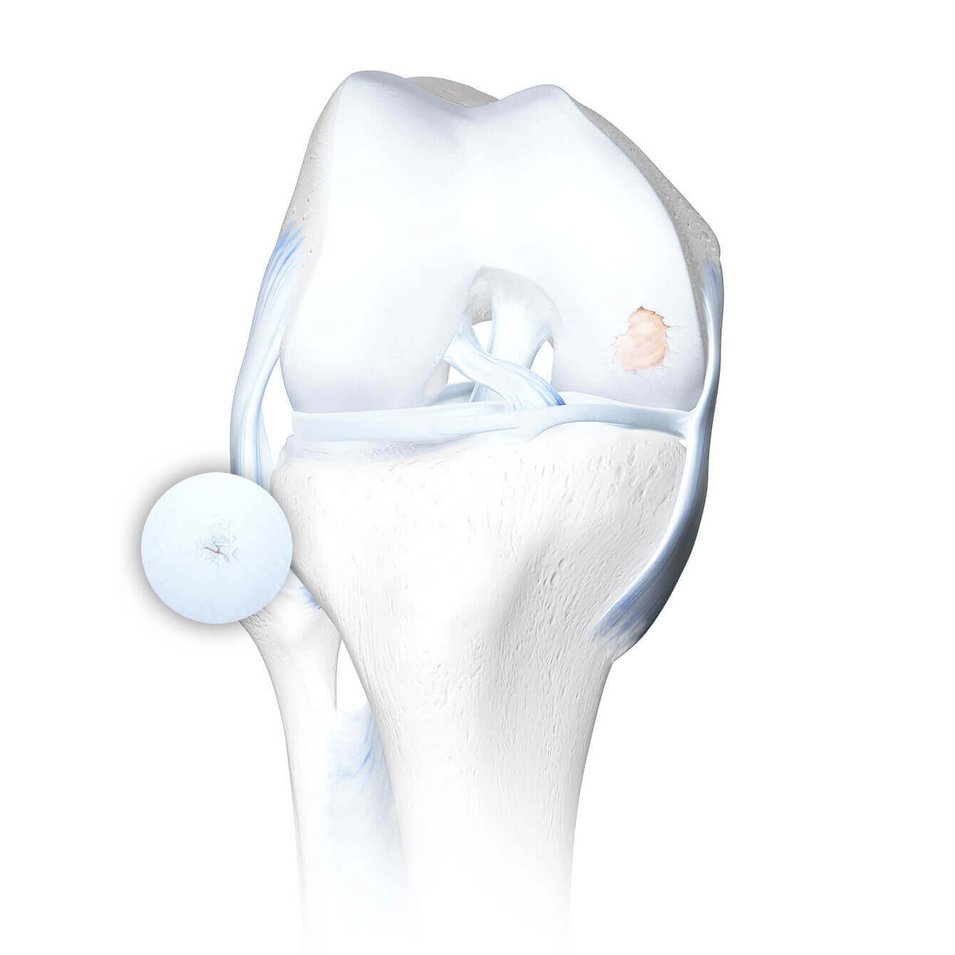 Grafische Darstellung eines Kniegelenks mit Arthrose, in vier Stadien fortschreitender Knorpelschädigung