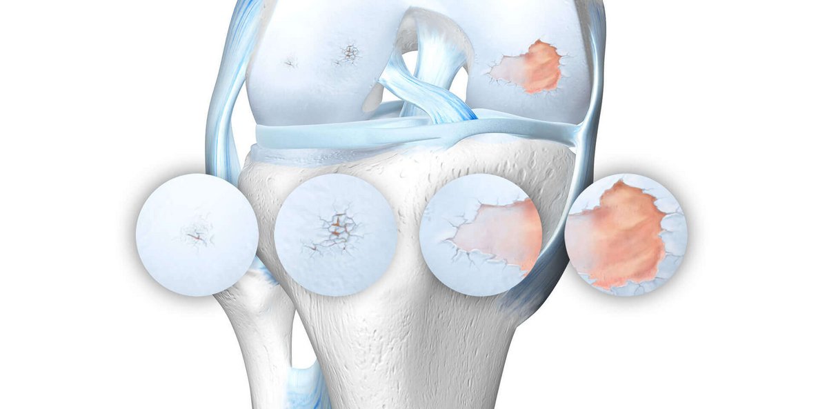 Schematische Darstellung des Kniegelenks bei einer vorliegenden Gonarthrose, inklusive der vier Arthrose-Stadien.