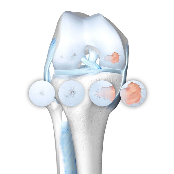 Schematische Darstellung des Kniegelenks bei einer vorliegenden Gonarthrose, inklusive der vier Arthrose-Stadien.