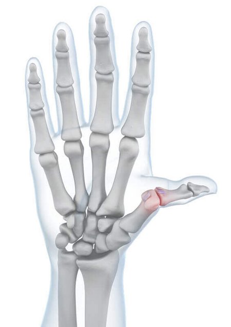 Darstellung der Anatomie der Hand mit einer vorliegenden Skidaumen-Erkrankung.
