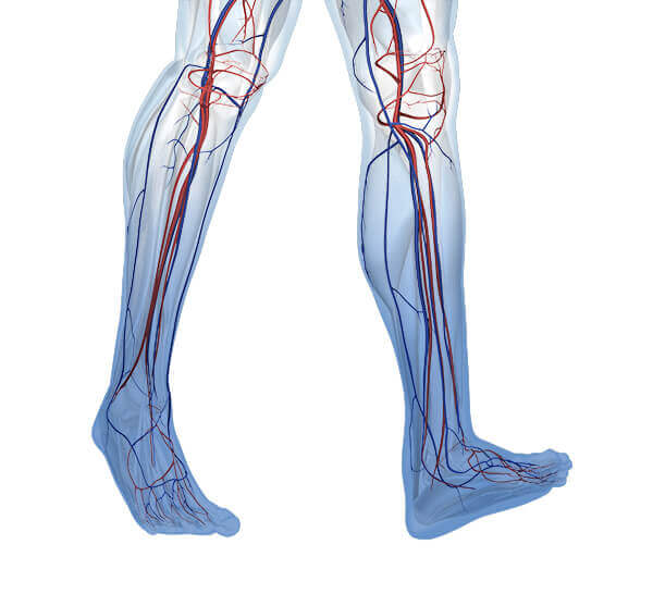 Darstellung der Anatomie von Beinen mit einer Erkrankung an einer chronisch-venösen Insuffizienz (CVI). Dahinter verbirgt sich eine allgemeine Venenschwäche.