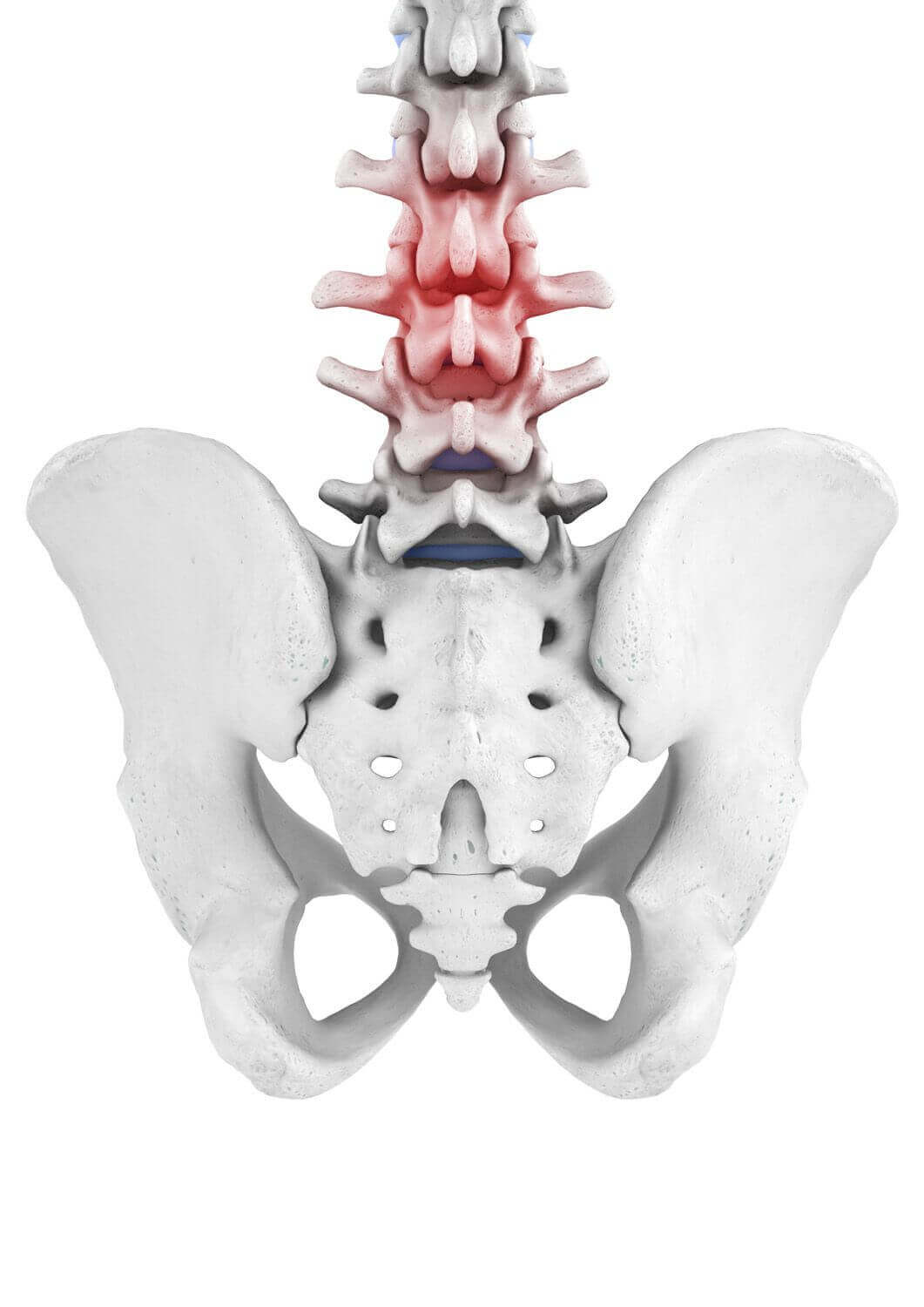 Darstellung der Anatomie der Wirbelsäule bei einem vorliegenden LWS-Syndrom. Unter einem akuten LWS-Syndrom - umgangssprachlich auch Hexenschuss genannt - versteht man einen ganz plötzlich auftretenden, sehr heftigen und stechenden Schmerz im Bereich der Lendenwirbelsäule.
